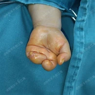 Pembedahan Sindrom Band Amniotik